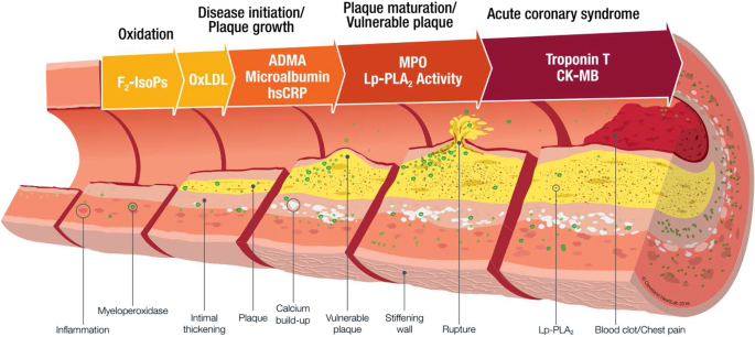 Atherosclerotic plaque progression and regression with treatment