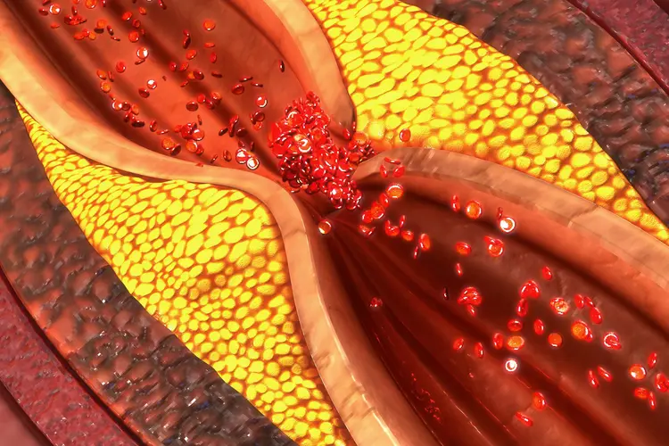 Atherosclerotic plaque buildup in blood vessel