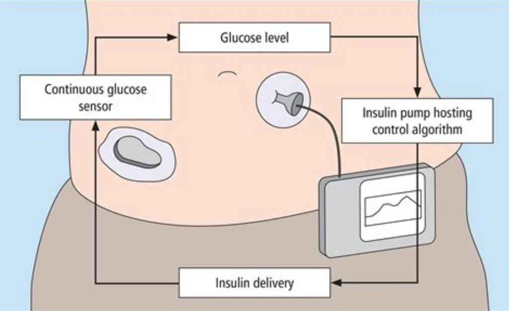 Closed-loop insulin monitoring system showing continuous glucose sensor, insulin pump, and control algorithm